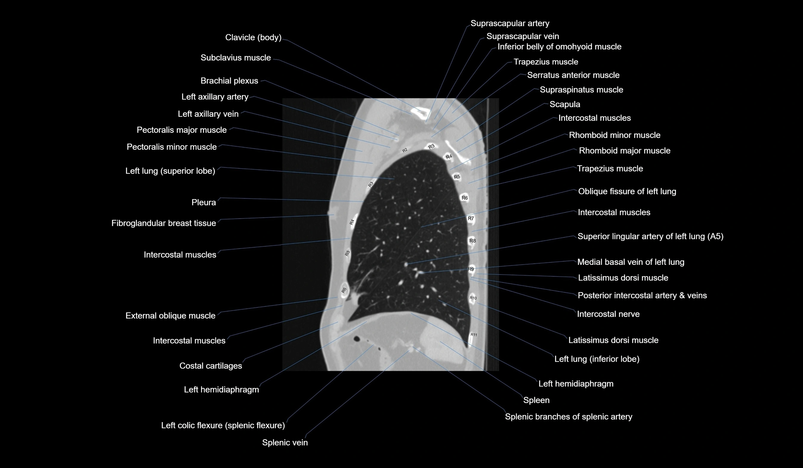 CT chest (thorax) lung window labelled sagittal cross sectional anatomy radiology image-00114.webp